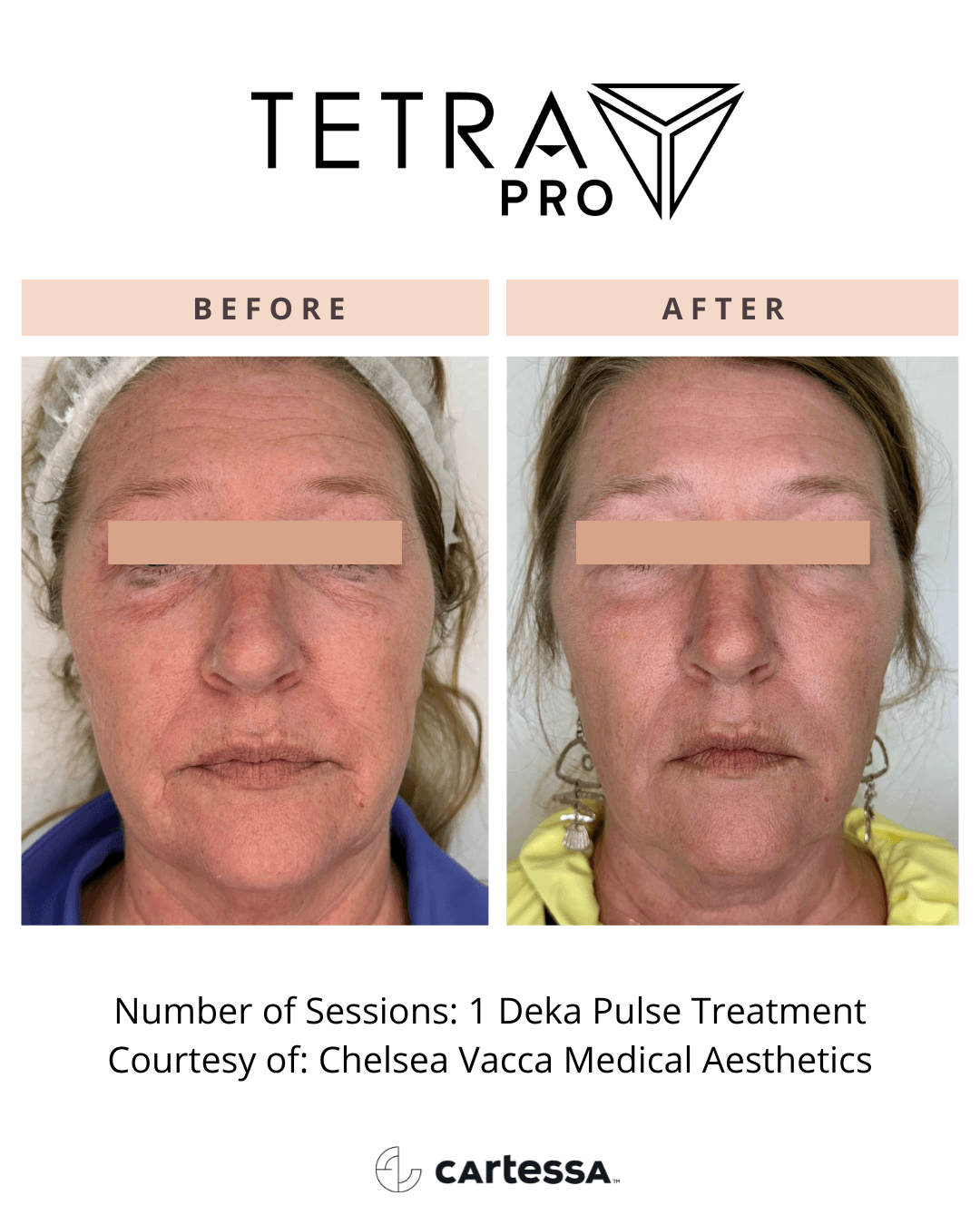 Tetra Pro B&A 03