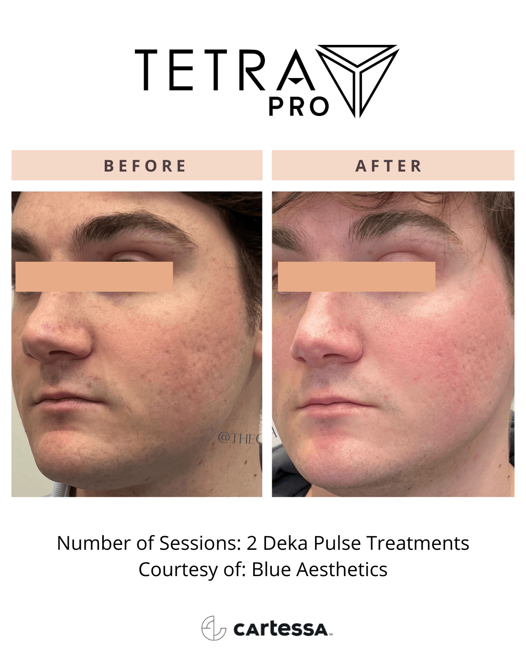 Tetra Pro B&A 04