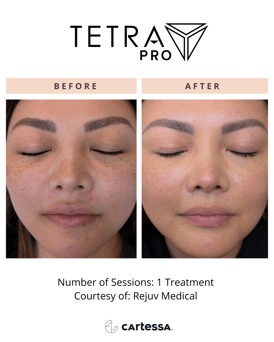 Tetra Pro B&A 05