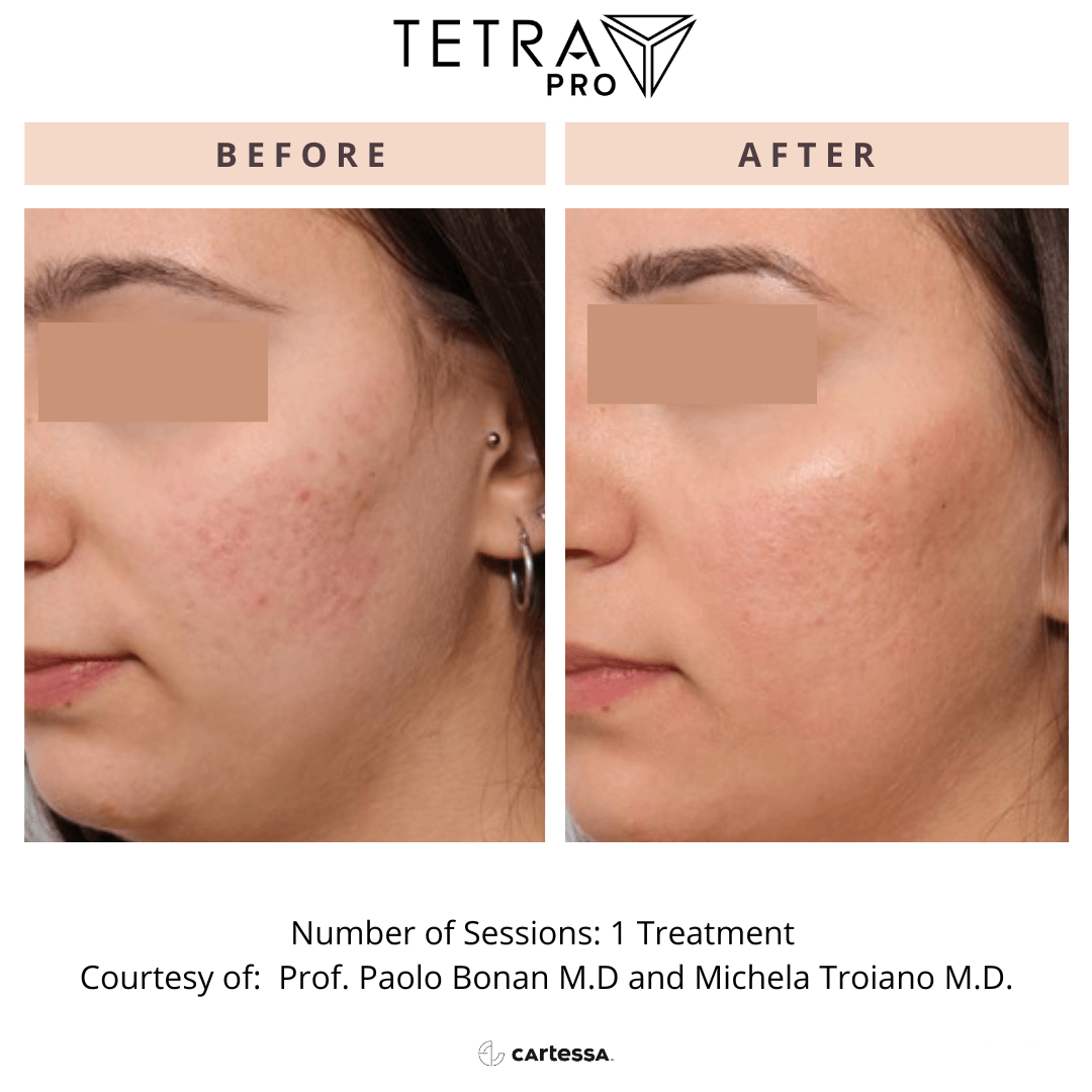 Tetra Pro B&A 07