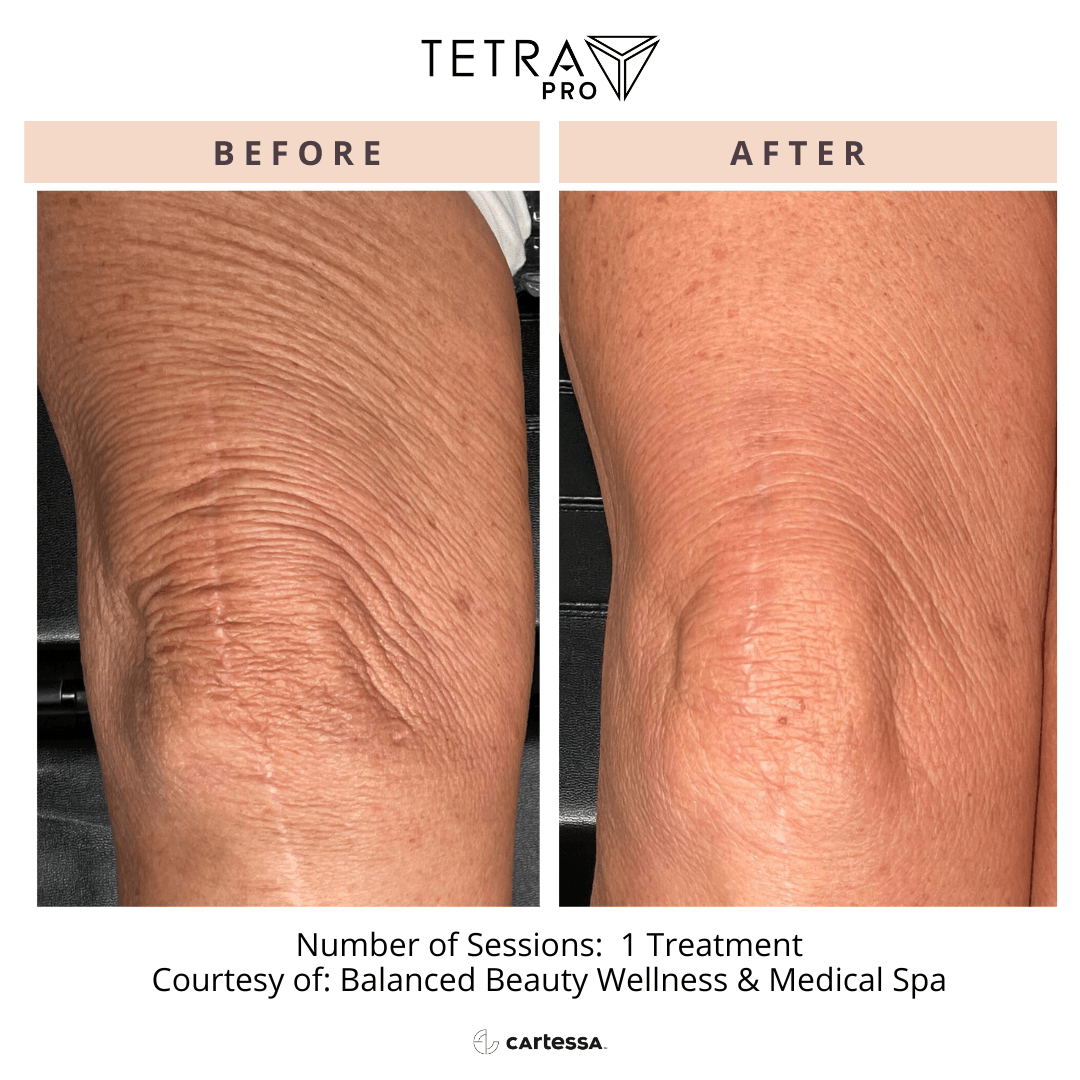 Tetra Pro B&A 08