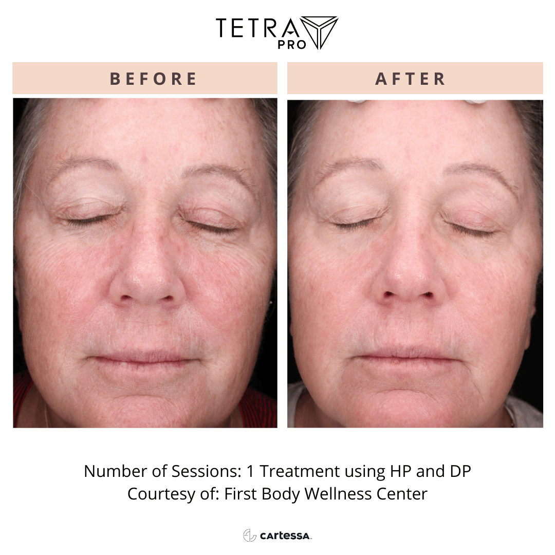 Tetra Pro B&A 09