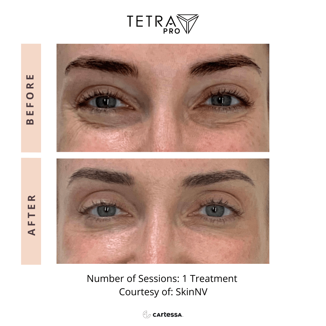 Tetra Pro B&A 10