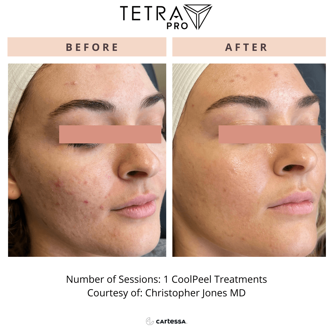 Tetra Pro B&A 11