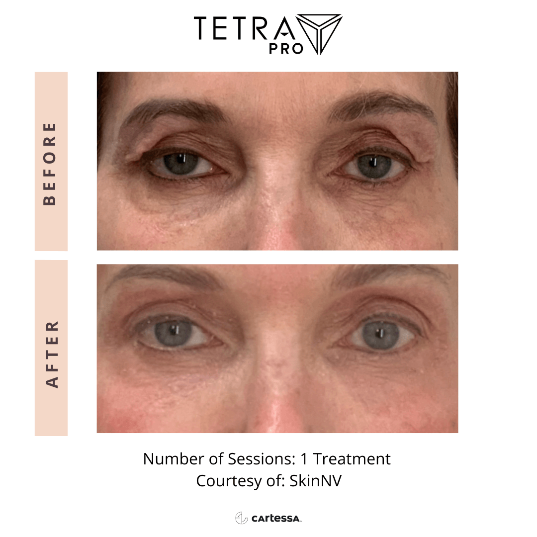 Tetra Pro B&A 12